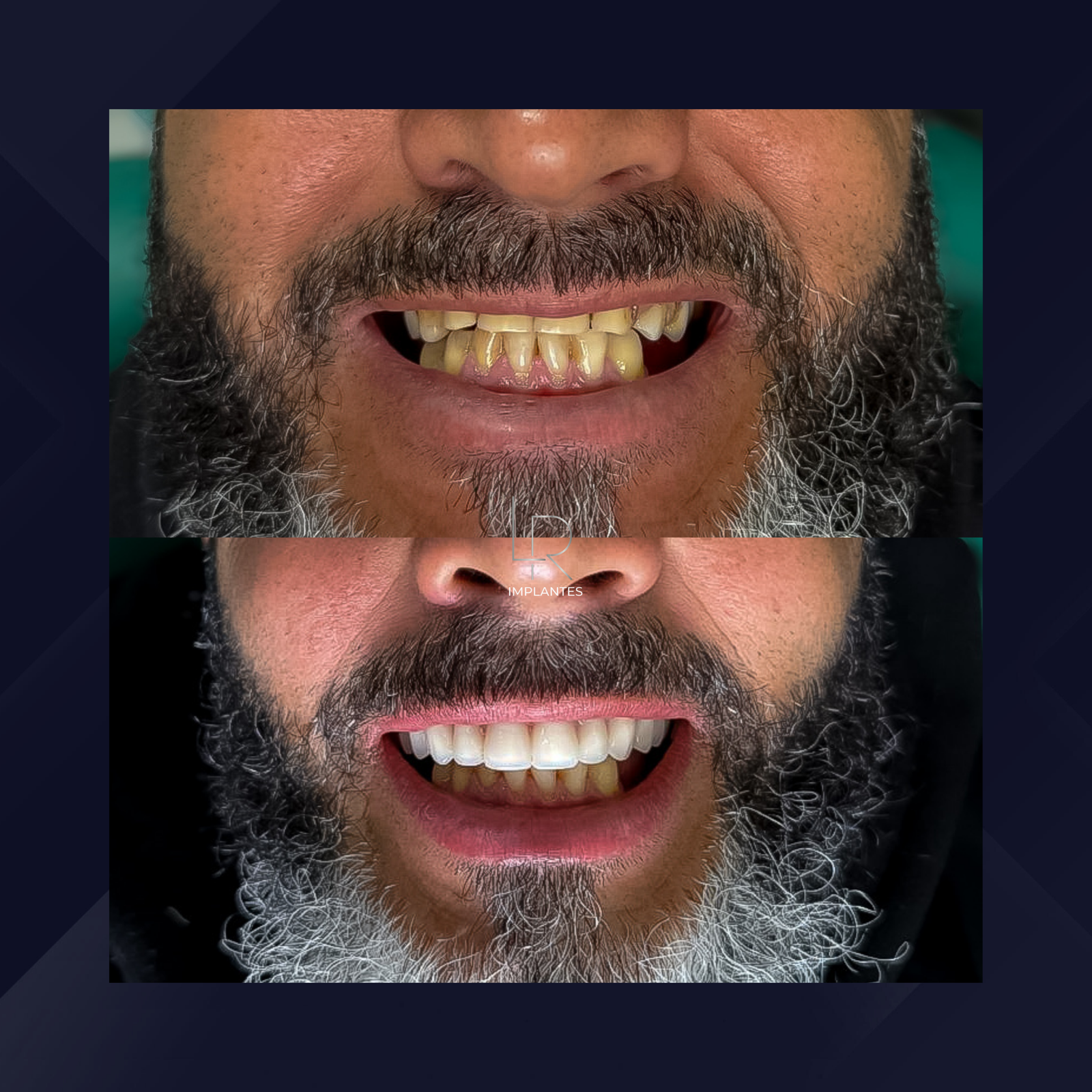 LR Implantes. Implante Dentário e Prótese Dentária. #1.1.E