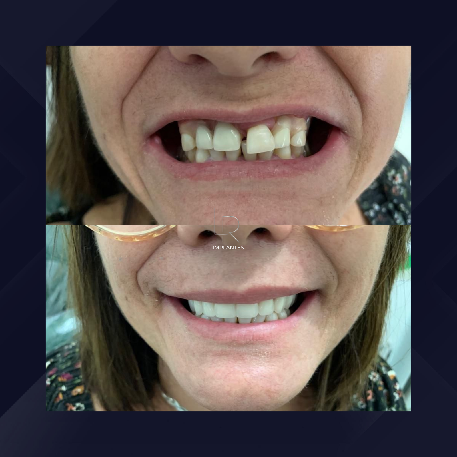 LR Implantes. Implante Dentário e Prótese Dentária. #10.1.E