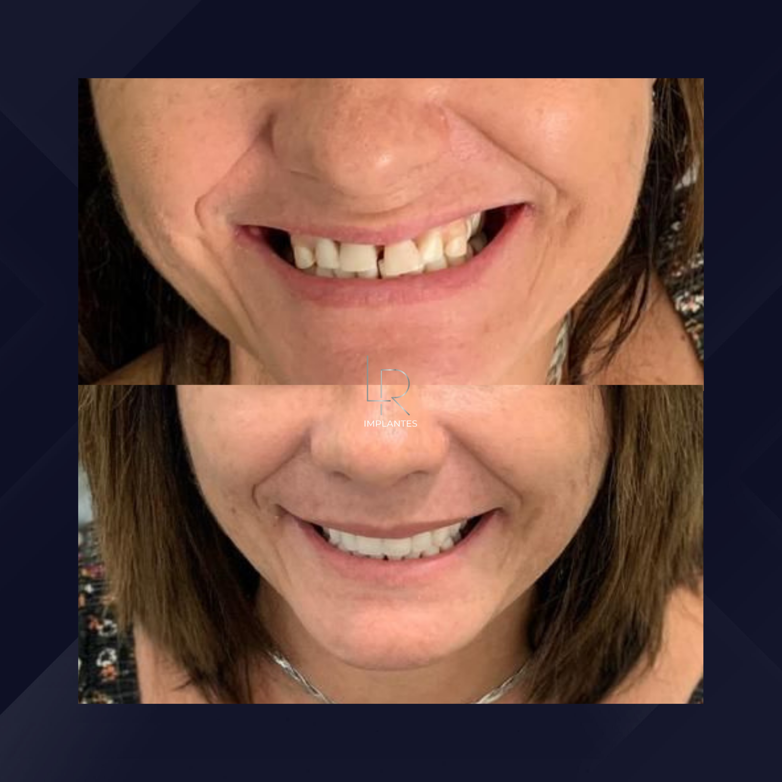 LR Implantes. Implante Dentário e Prótese Dentária. #11.1.E