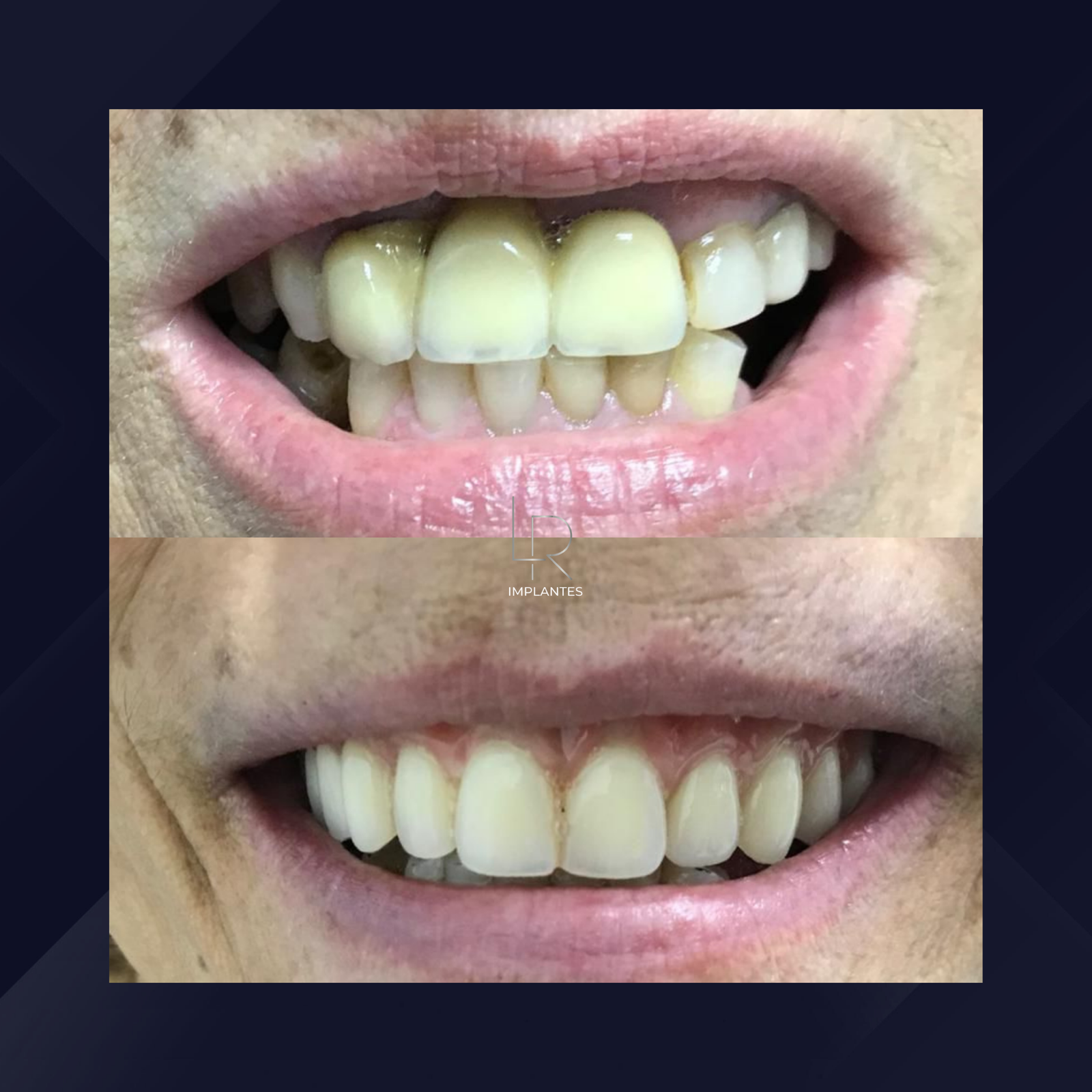 LR Implantes. Implante Dentário e Prótese Dentária. #12.1.E