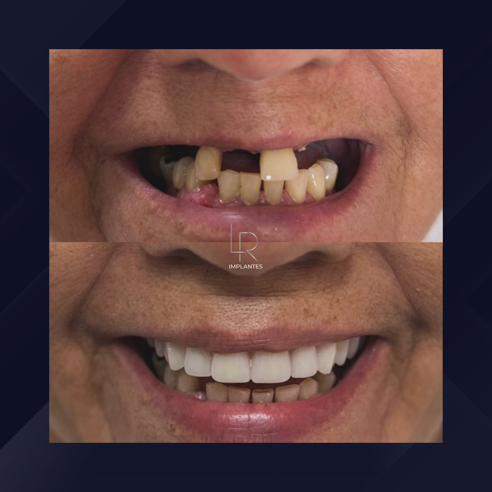 LR Implantes. Implante Dentário e Prótese Dentária. #13.1.E