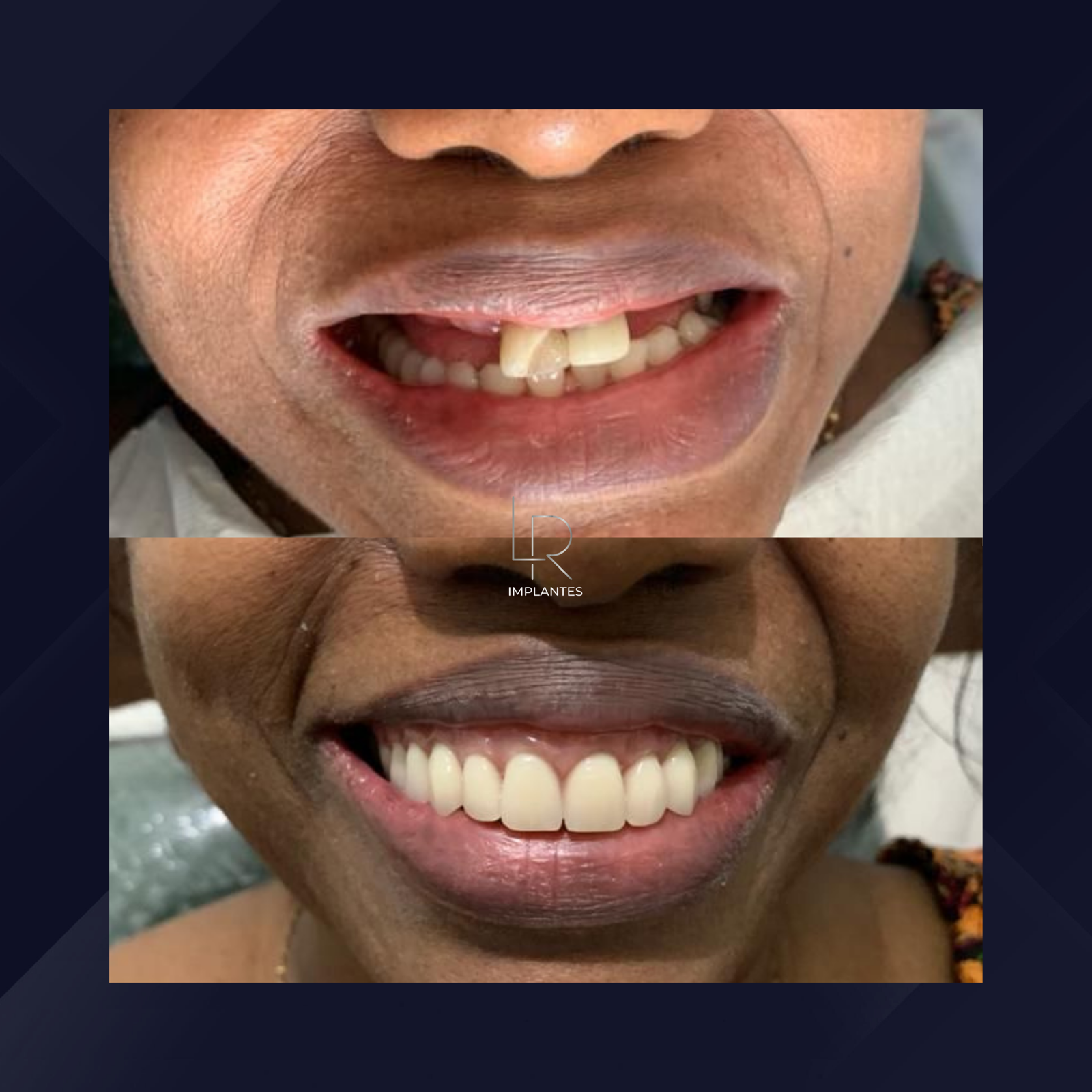 LR Implantes. Implante Dentário e Prótese Dentária. #14.1.E