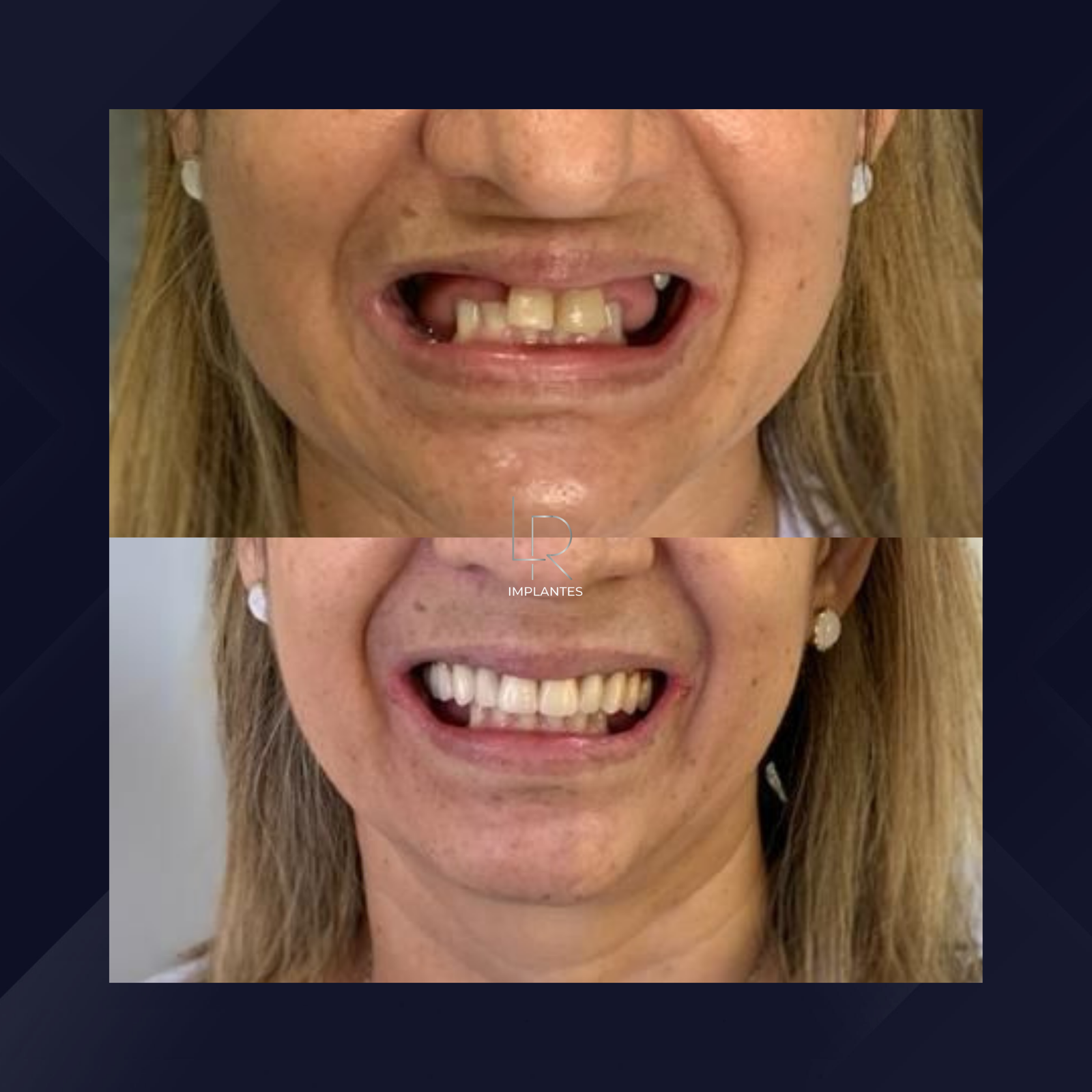 LR Implantes. Implante Dentário e Prótese Dentária. #15.1.E