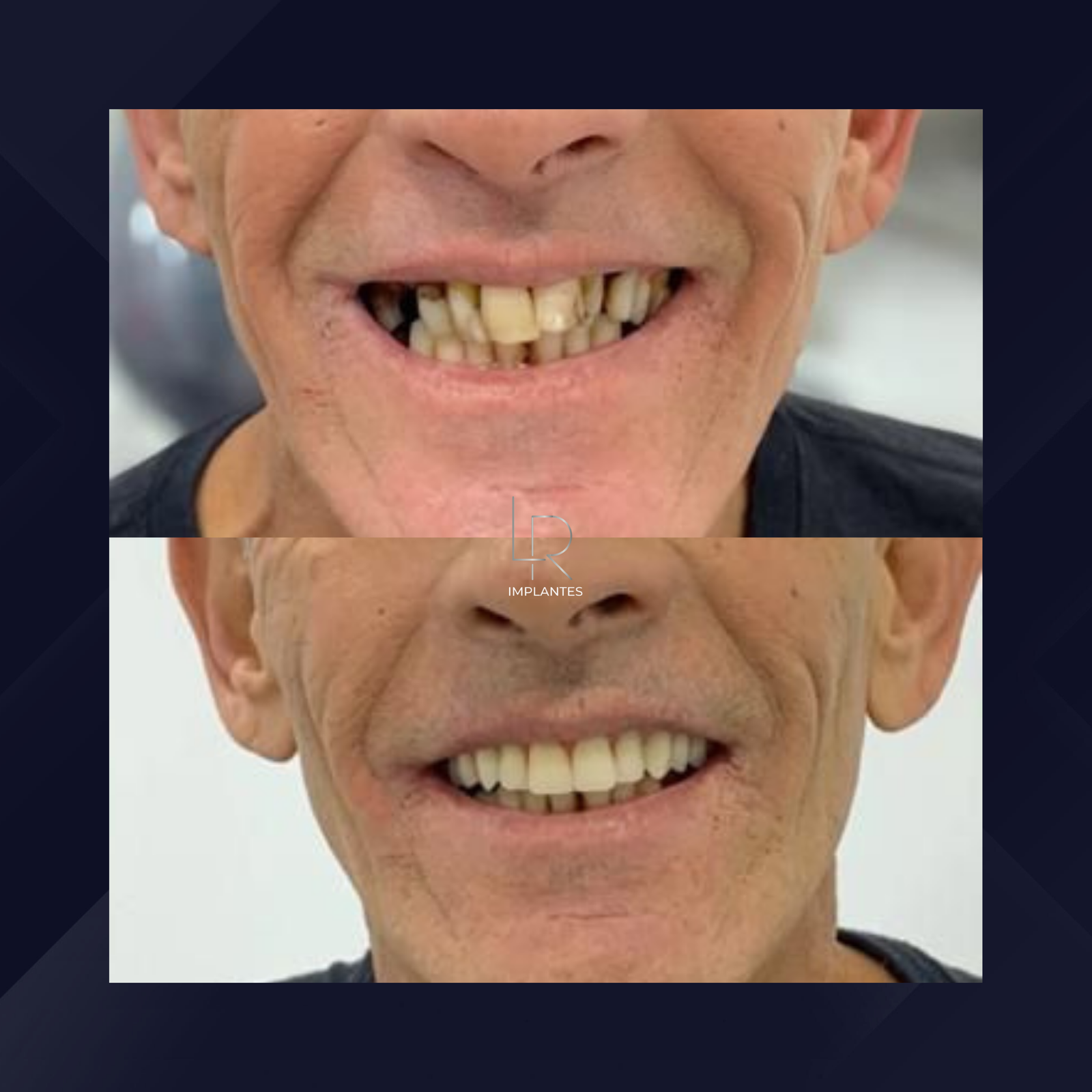 LR Implantes. Implante Dentário e Prótese Dentária. #16.1.E