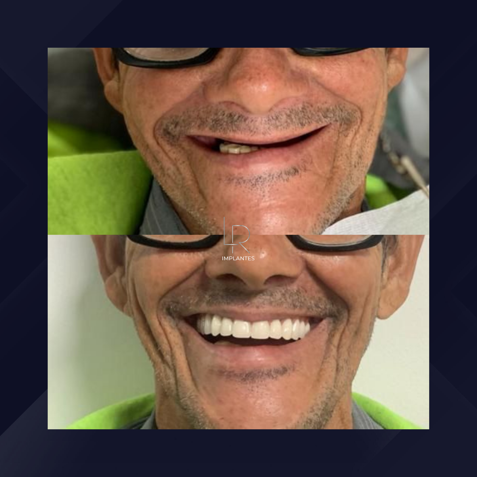 LR Implantes. Implante Dentário e Prótese Dentária. #17.1.E