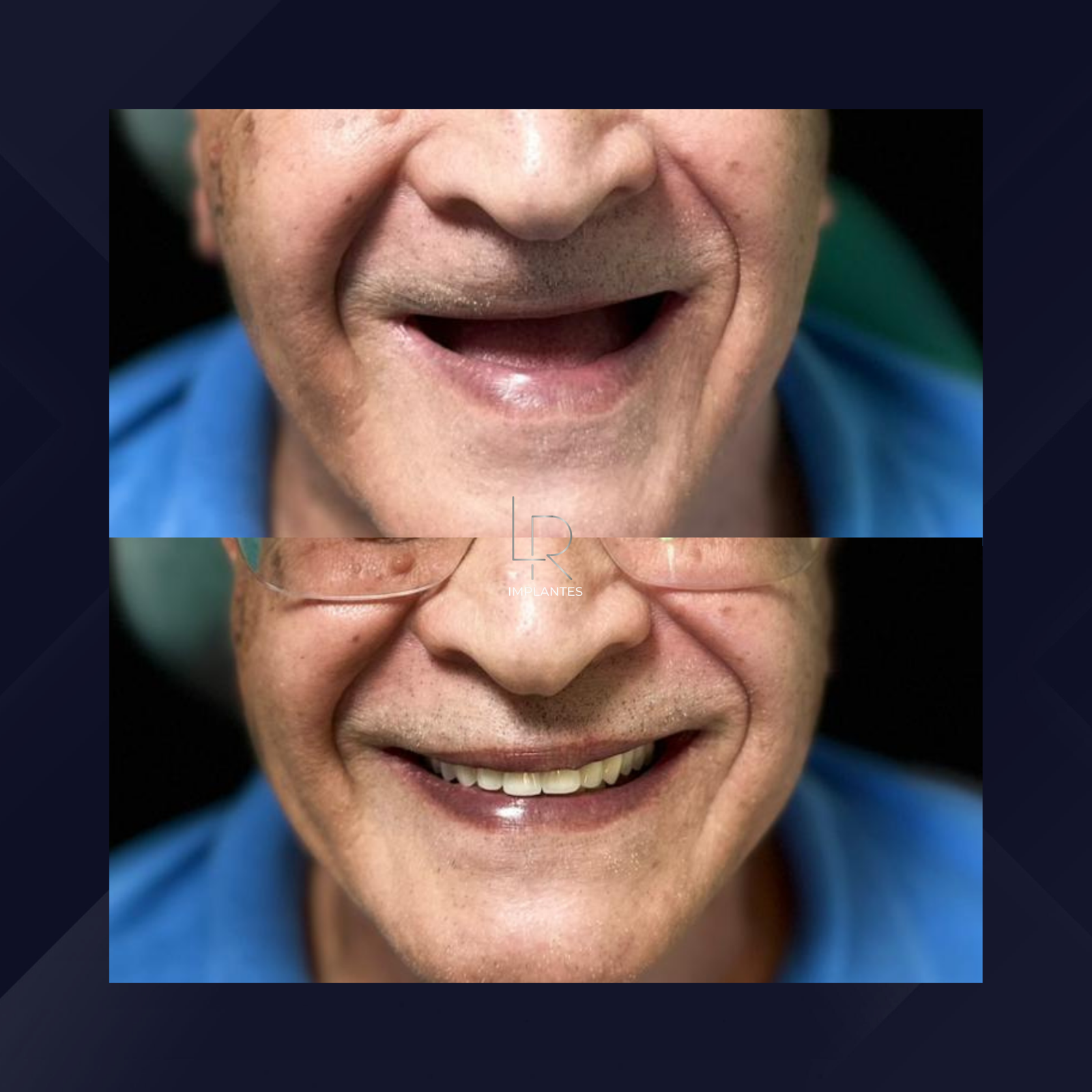 LR Implantes. Implante Dentário e Prótese Dentária. #2.1.E