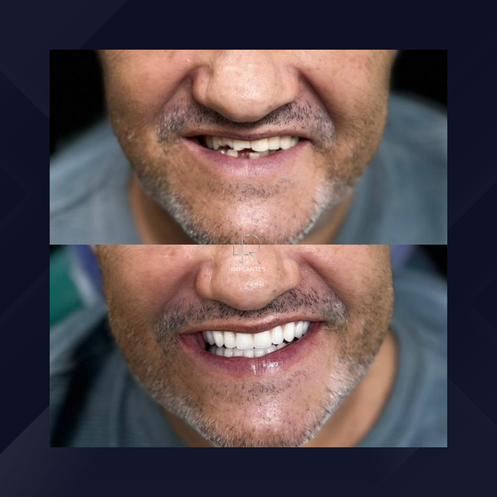 LR Implantes. Implante Dentário e Prótese Dentária. #3.1.E