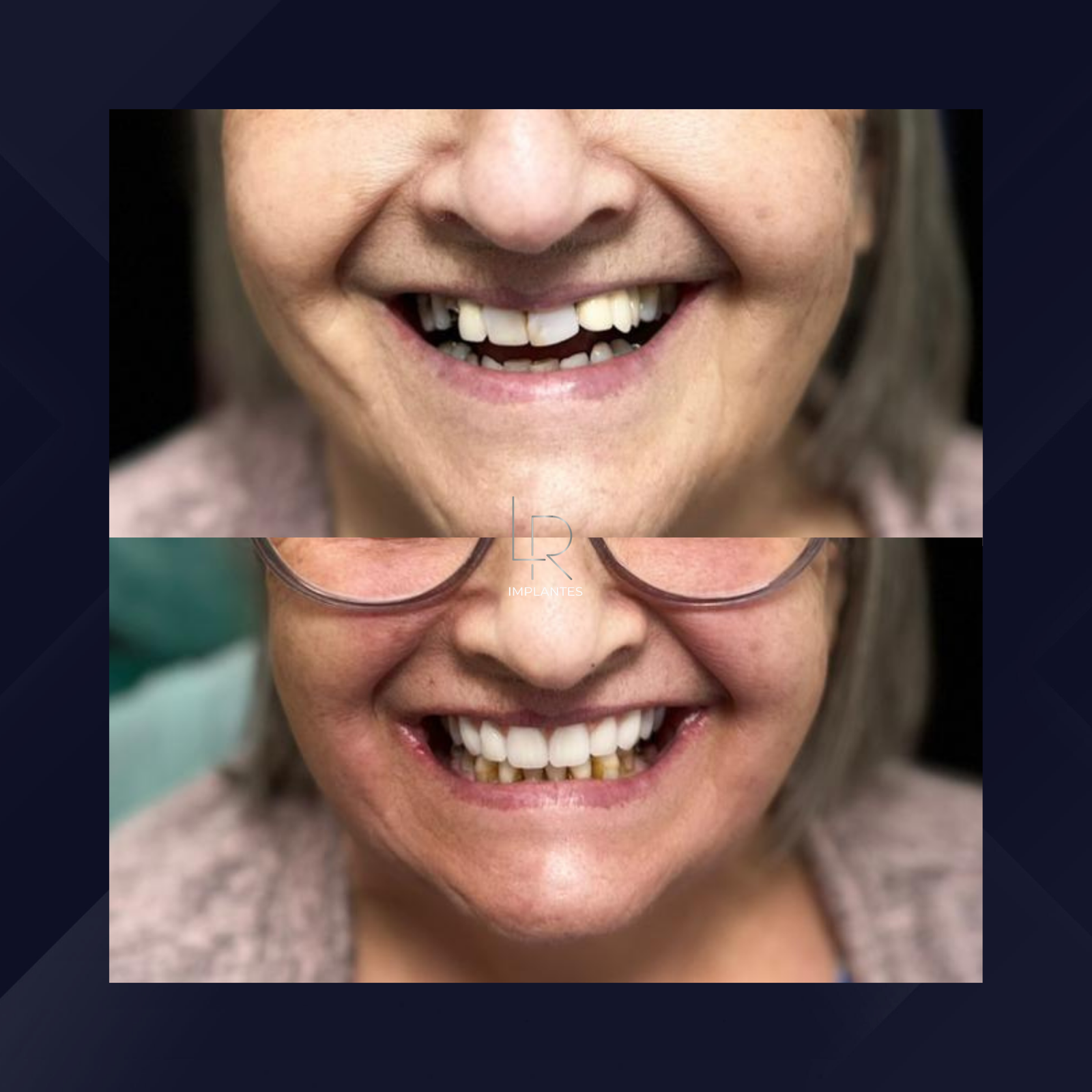 LR Implantes. Implante Dentário e Prótese Dentária. #4.1.E