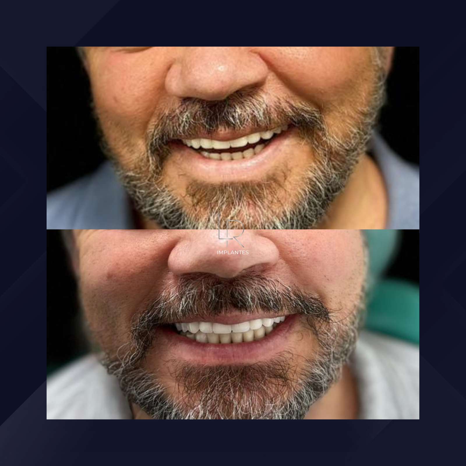 LR Implantes. Implante Dentário e Prótese Dentária. #5.1.E