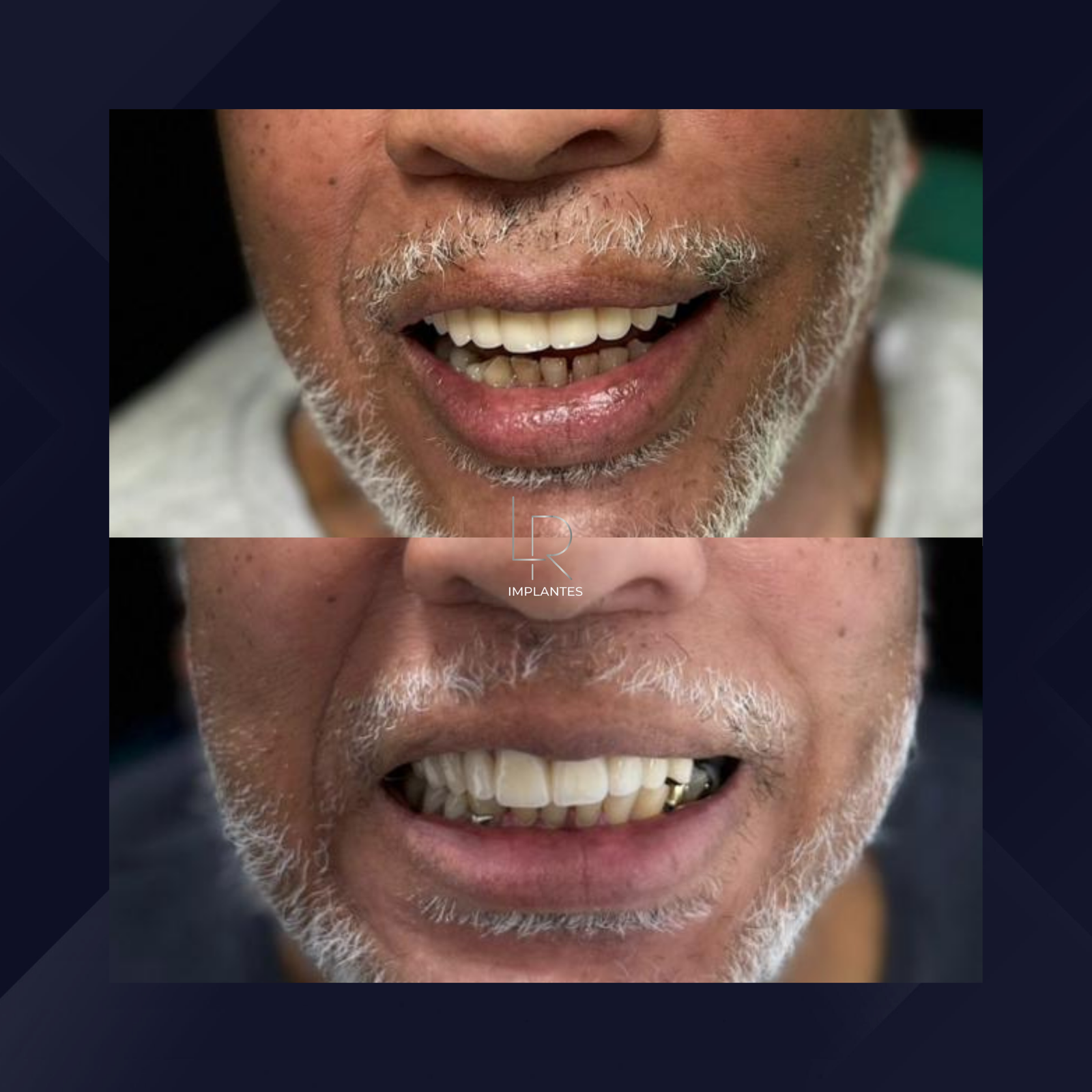 LR Implantes. Implante Dentário e Prótese Dentária. #6.1.E