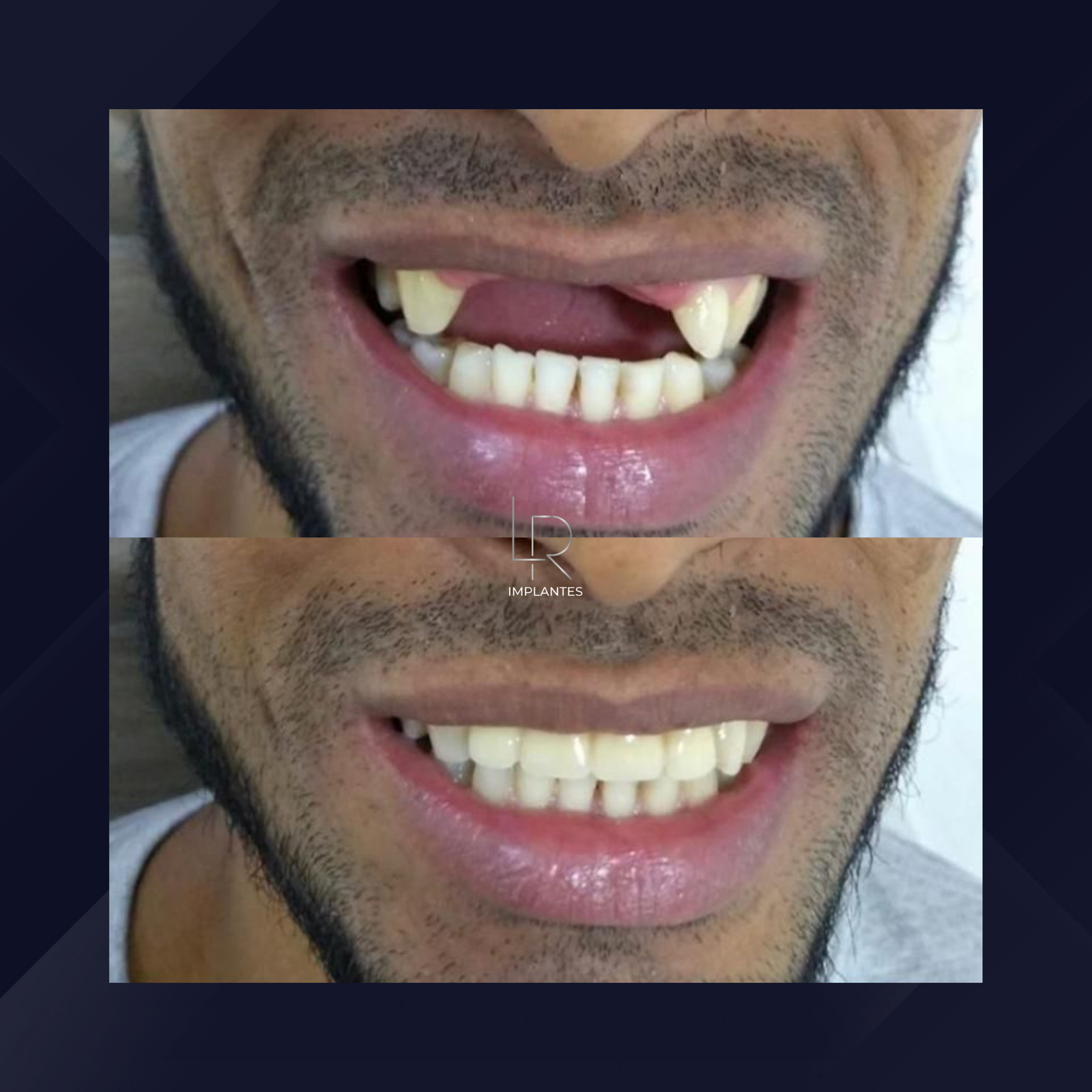 LR Implantes. Implante Dentário e Prótese Dentária. #7.1.E