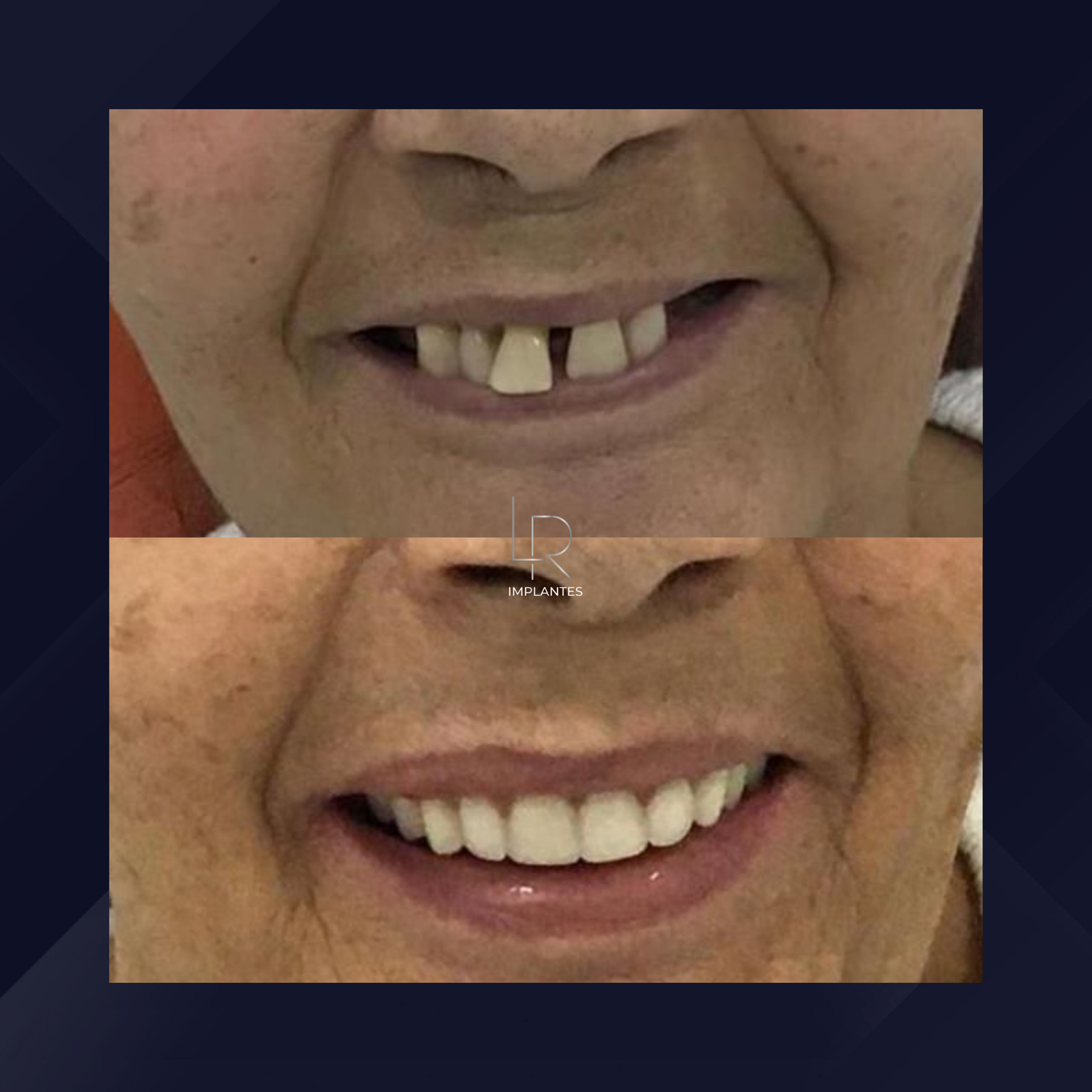 LR Implantes. Implante Dentário e Prótese Dentária. #8.1.E