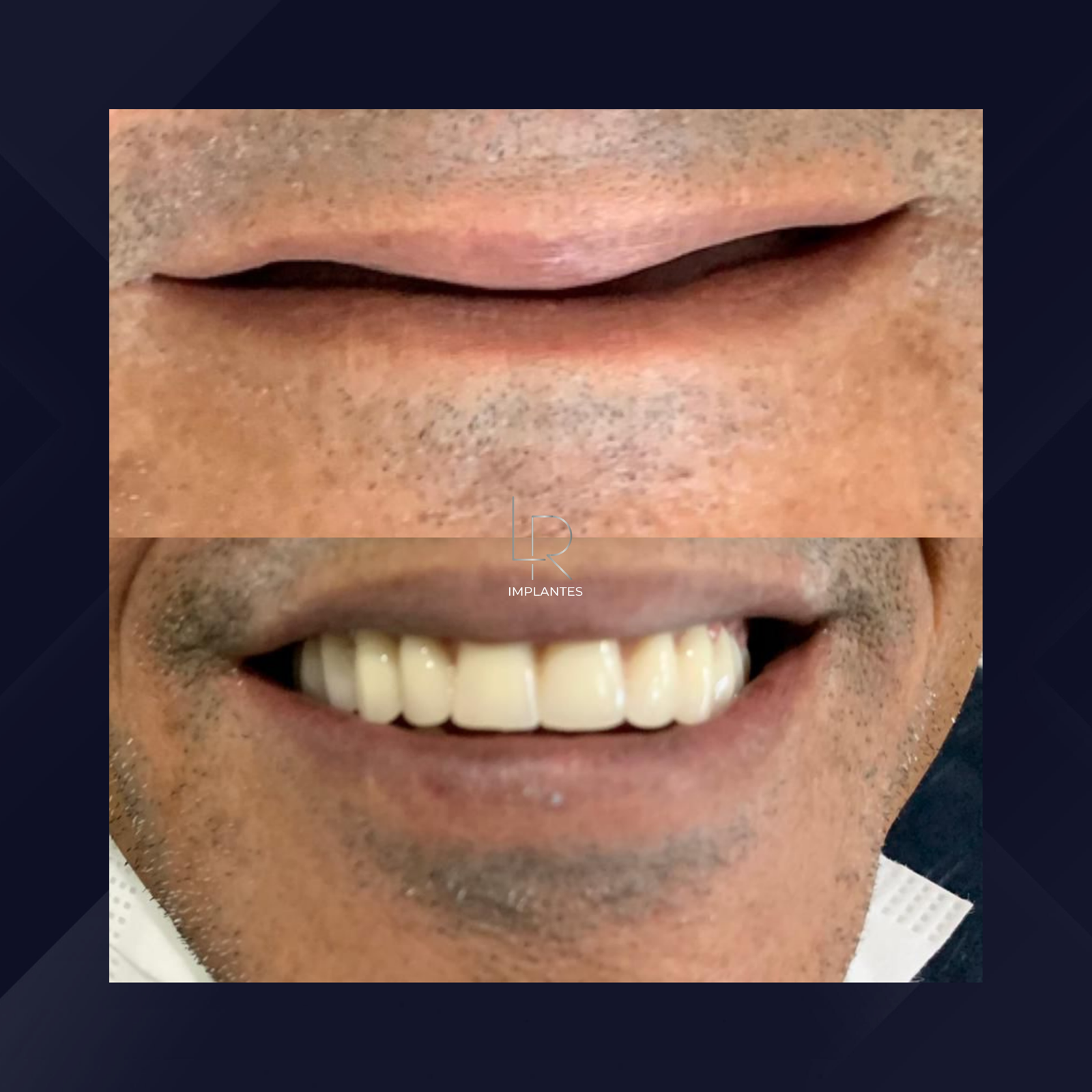 LR Implantes. Implante Dentário e Prótese Dentária. #9.1.E